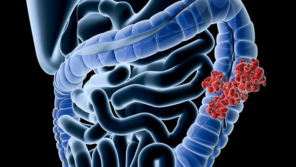 Colon Cancer
